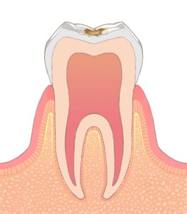 虫歯治療にはどんな治療がある？白い詰め物CR充填
